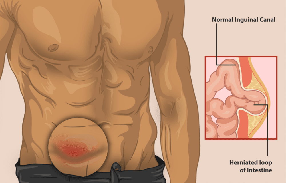 Waspadai Hernia Inguinalis di Tempat Kerja